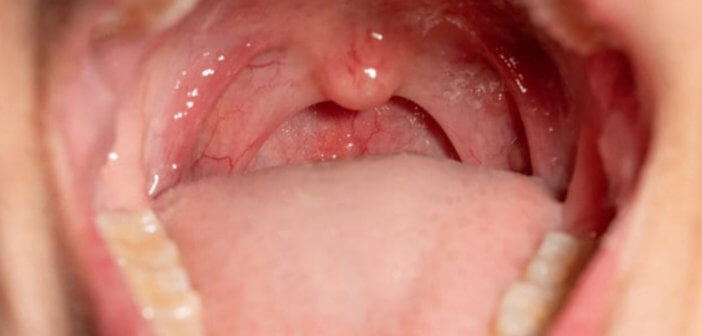 Placche in gola: cause, rimedi naturali, quanto durano